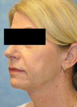 Ulthera – Case 1