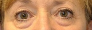 Blepharoplasty – Case 9