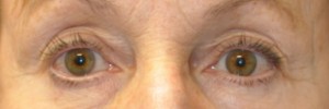 Blepharoplasty – Case 10