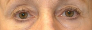 Blepharoplasty – Case 10