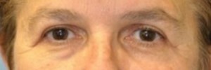 Blepharoplasty – Case 11