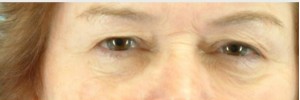 Blepharoplasty – Case 12