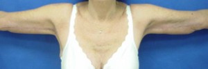 After Image: Brachioplasty – Case 1 - front