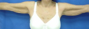 Before Image: Brachioplasty – Case 1 - front
