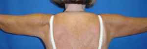 After Image: Brachioplasty – Case 2 - front