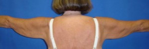 Before Image: Brachioplasty – Case 2 - front