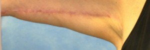 After Image: Brachioplasty – Case 10 - front