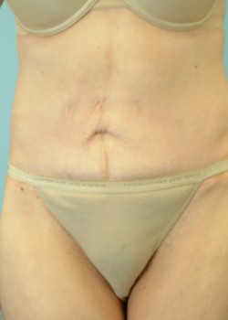 After Image: Body Lift – Case 1 - front