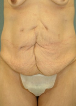Before Image: Body Lift – Case 1 - front