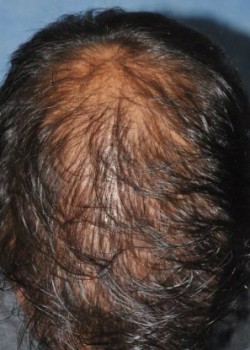 After Image: NeoGraft – Case 1 - other