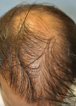 Before Image: NeoGraft – Case 1 - other