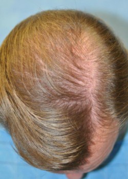 After Image: NeoGraft – Case 2