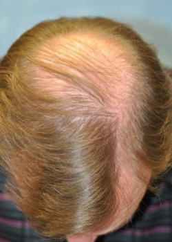 Before Image: NeoGraft – Case 2