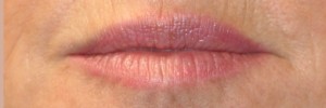 Before Image: Injections – Case 2 - front
