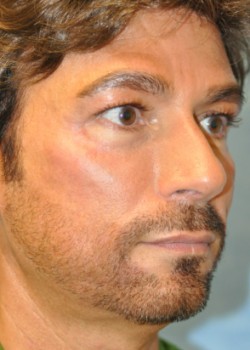 Injections – Case 4