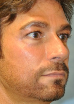 Injections – Case 4