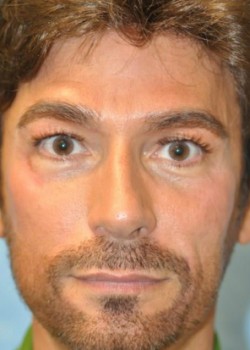 After Image: Injections – Case 4 - front