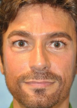 Before Image: Injections – Case 4 - front