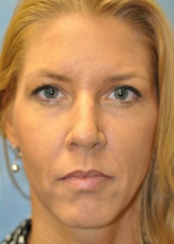 After Image: Injections – Case 10 - front