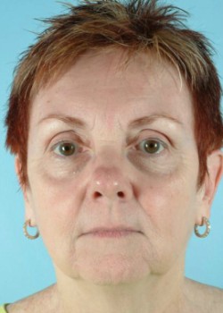 After Image: Injections – Case 12 - front