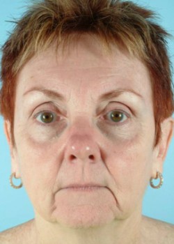 Before Image: Injections – Case 12 - front